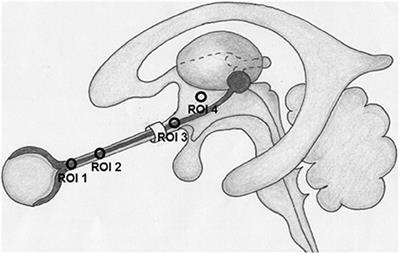 Perioptic Cerebrospinal Fluid Dynamics in Idiopathic Intracranial Hypertension